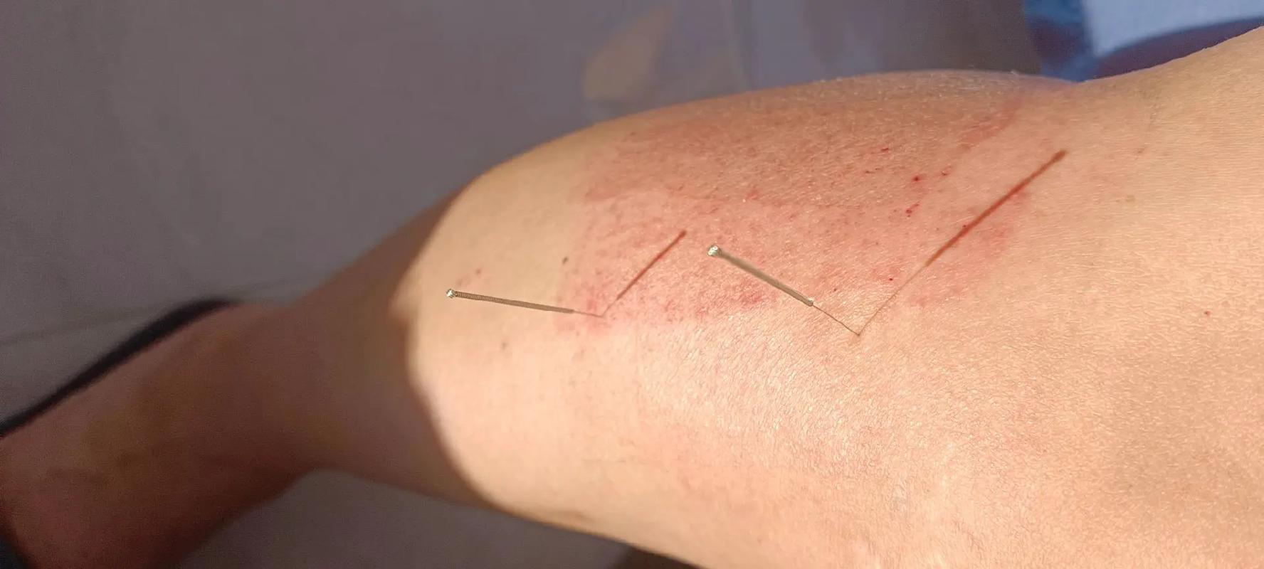 下肢淋巴水肿用针灸