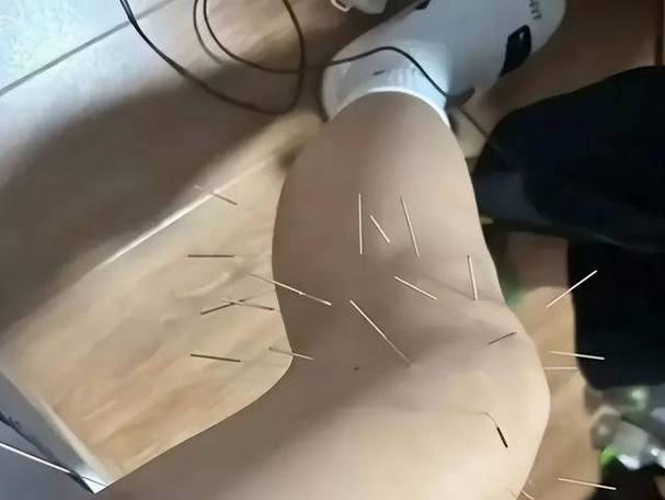 下肢淋巴水肿用针灸