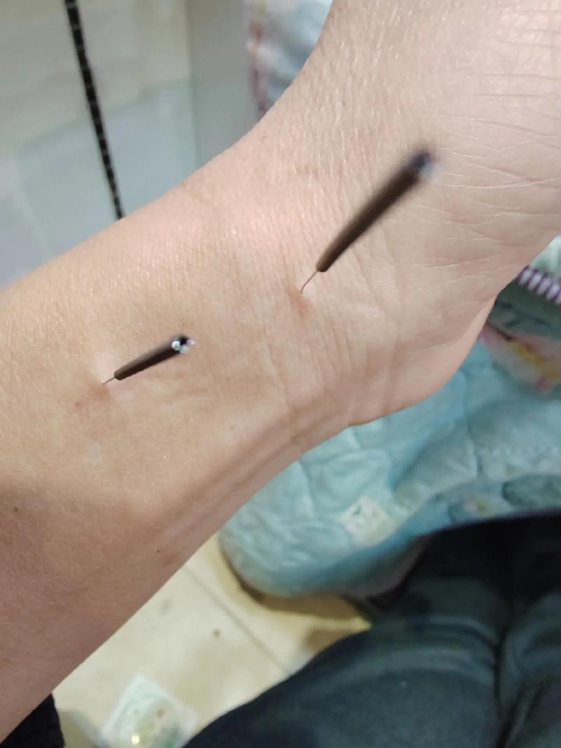 手上针灸有没有危险