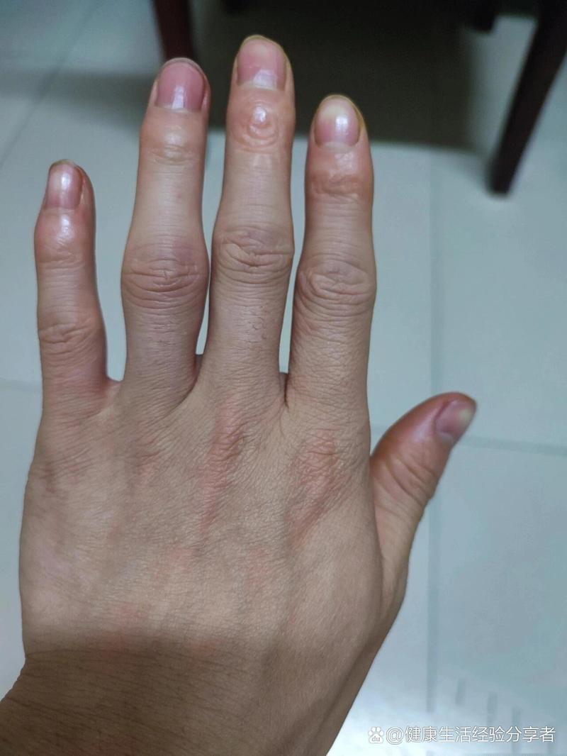 女性痛风的初期症状手