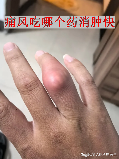 女性痛风的初期症状手