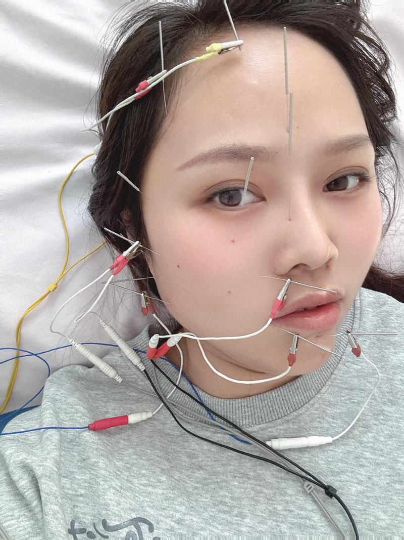 面瘫针灸出血正常吗