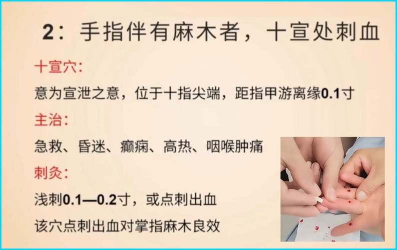 针灸治疗手指类风湿