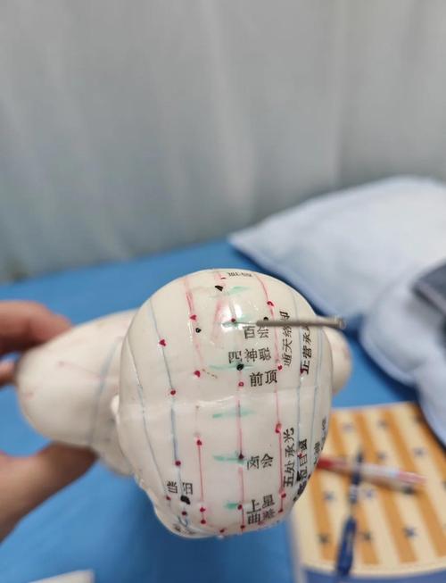 针灸腰背部怎么安全