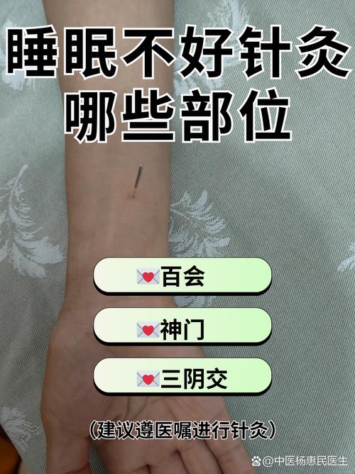 针灸治疗失眠扎哪里