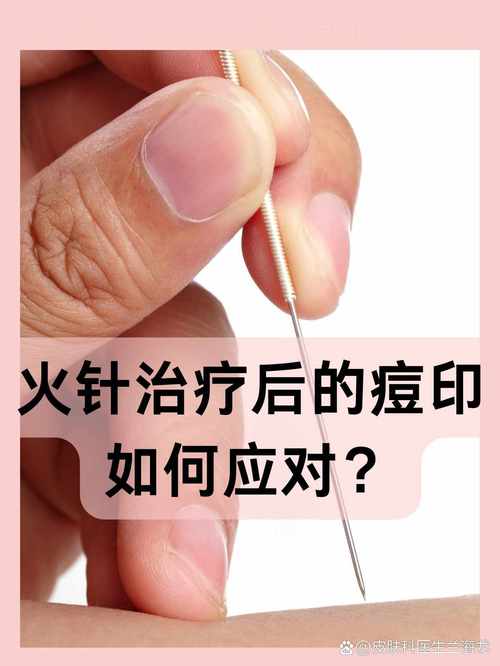 针灸治痤疮效果好吗