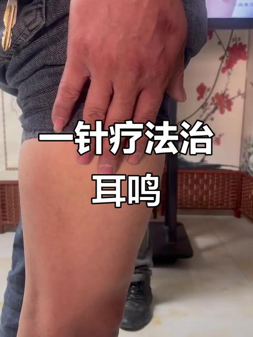 产后耳鸣可以针灸吗