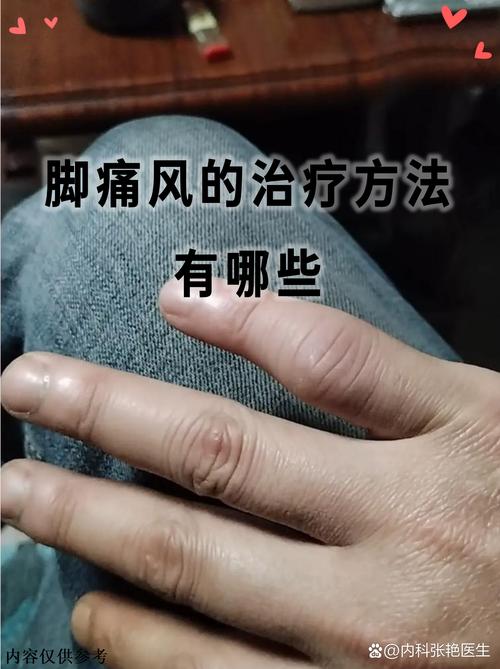 痛风为什么老是不消肿