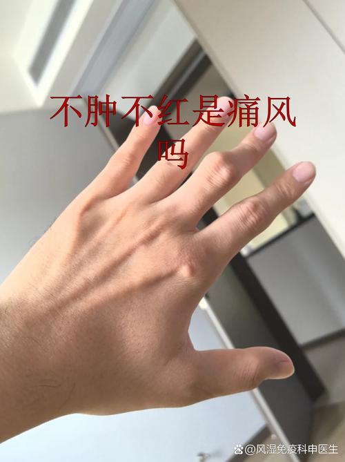 痛风为什么老是不消肿