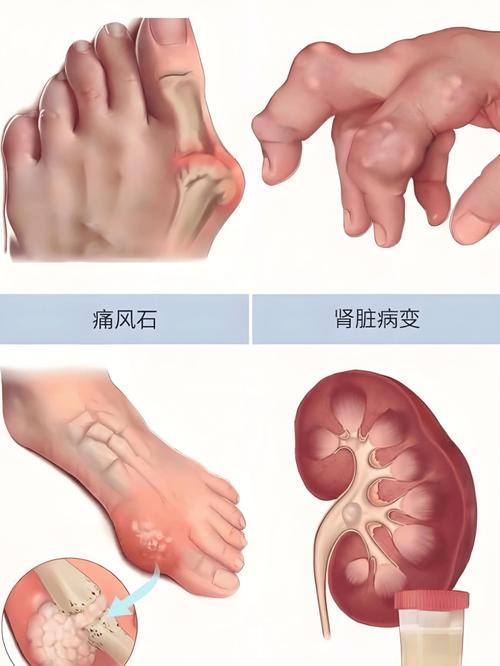 脚大拇指痛风治疗方法