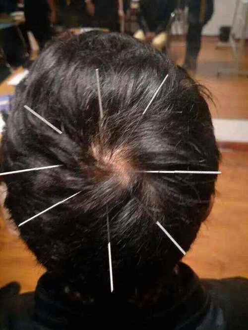 少阳经头疼针灸图片