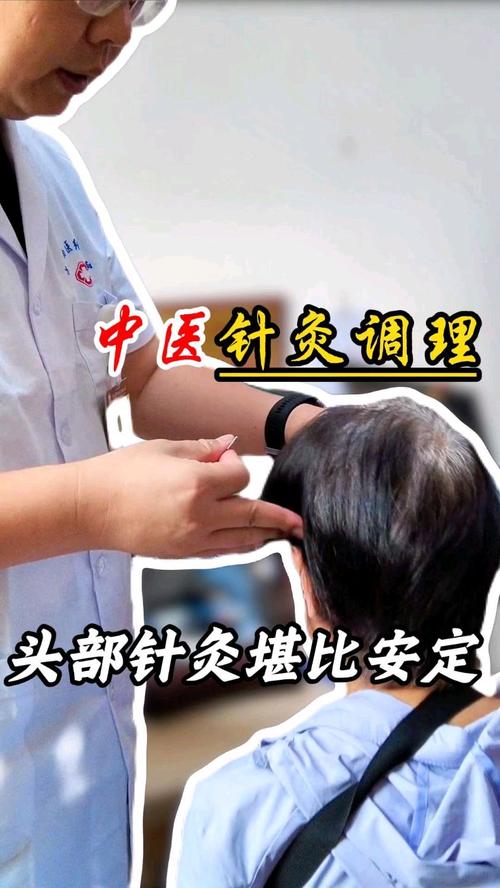 少阳经头疼针灸图片