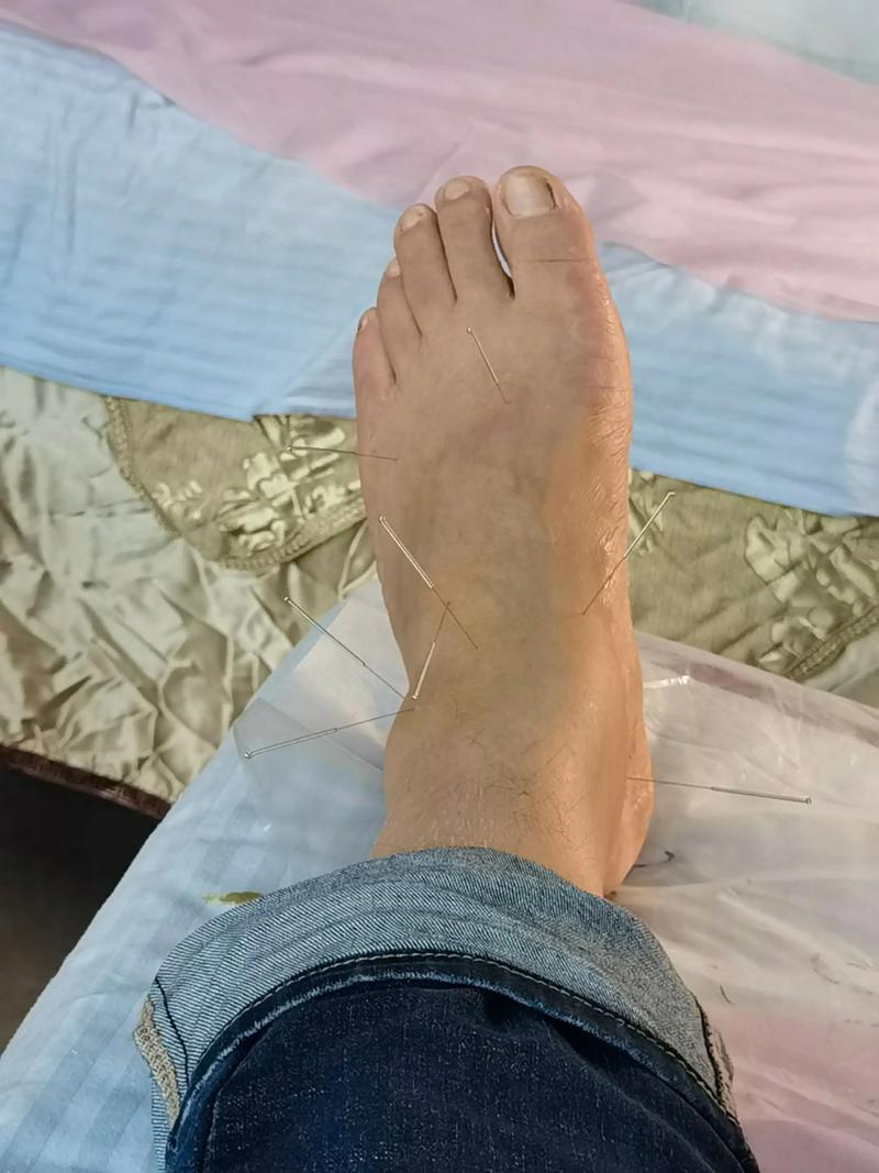 中医针灸治疗足跟痛