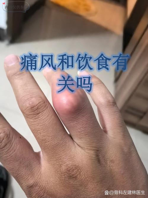 痛风会影响精子质量吗