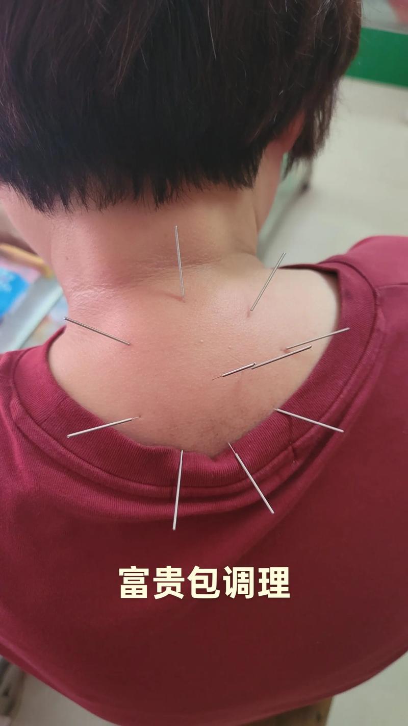 富贵包针灸效果怎样