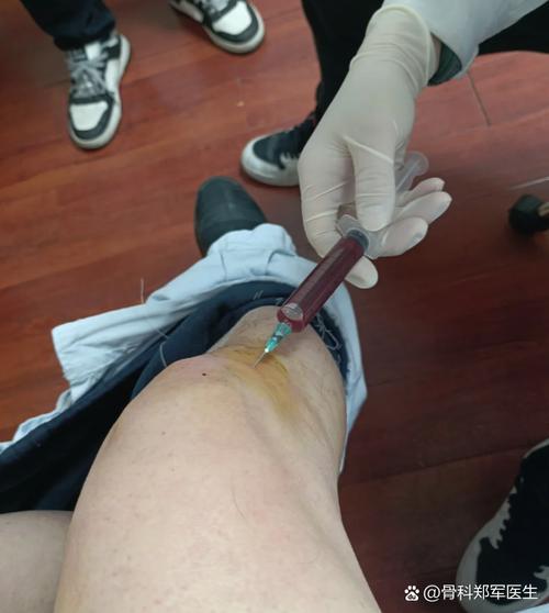 膝盖积水适合针灸吗