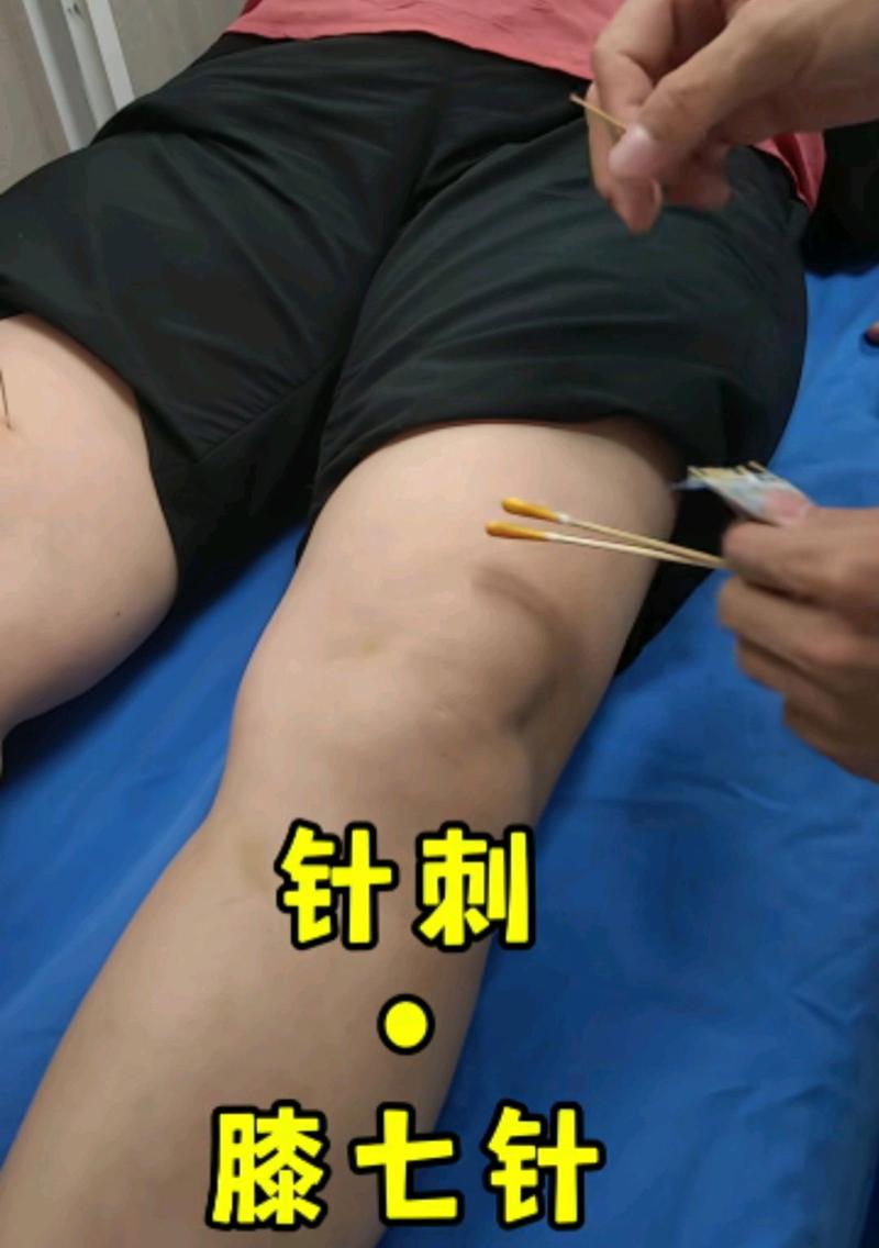 膝盖积水适合针灸吗