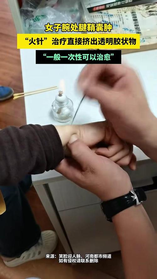 腱鞘囊肿的针灸治疗