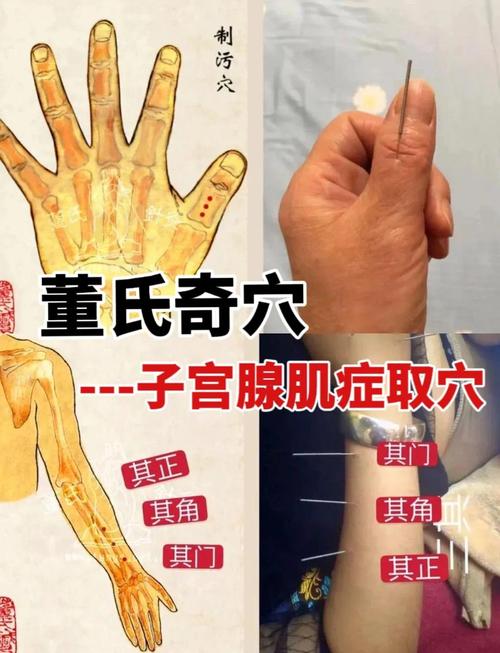 针灸治子宫肌瘤视频