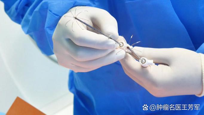 针灸治子宫肌瘤视频