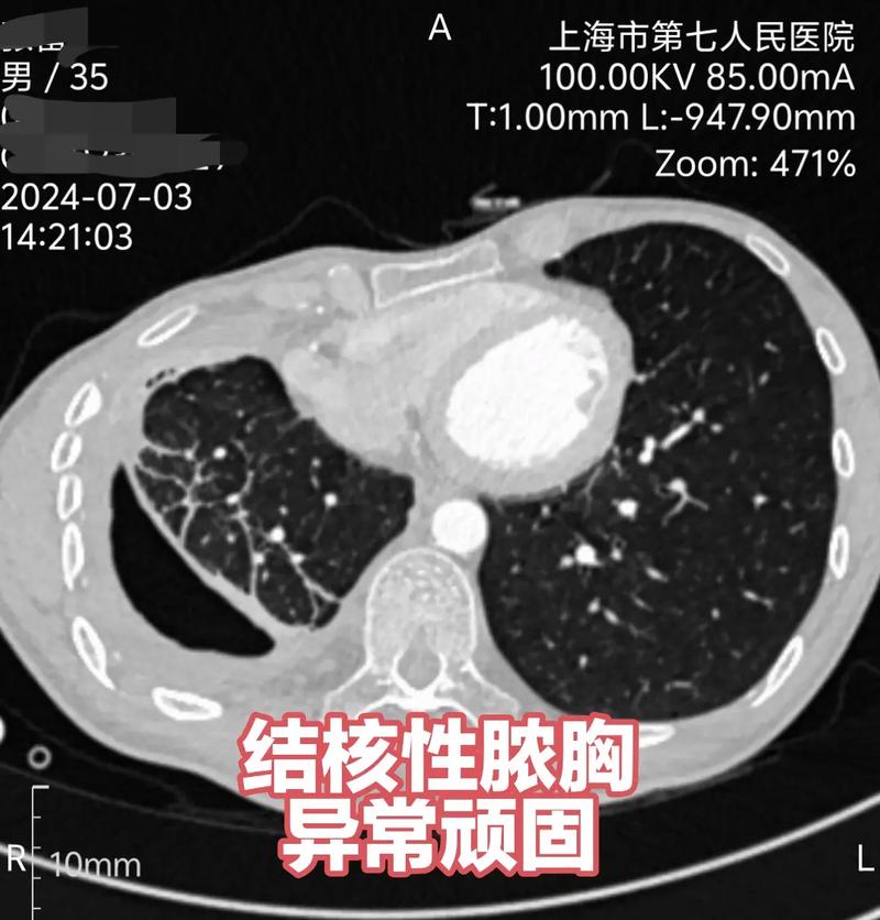 针灸导致气胸的症状