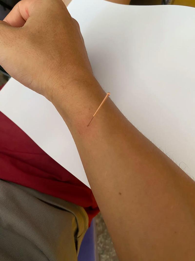 咽喉肿痛可以针灸吗