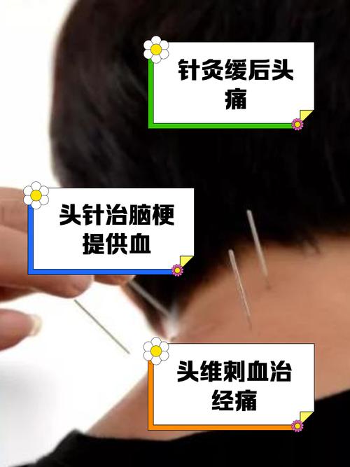 头部针灸有什么好处
