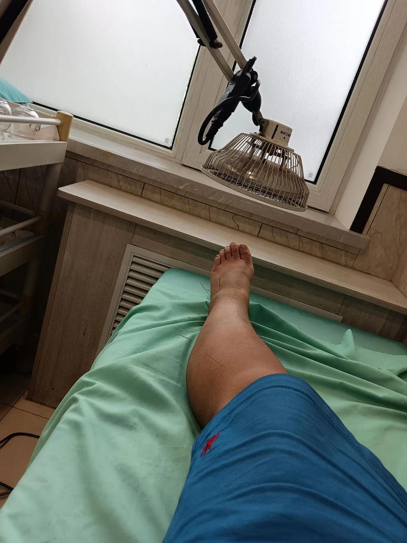 脚扭伤怎么针灸治疗