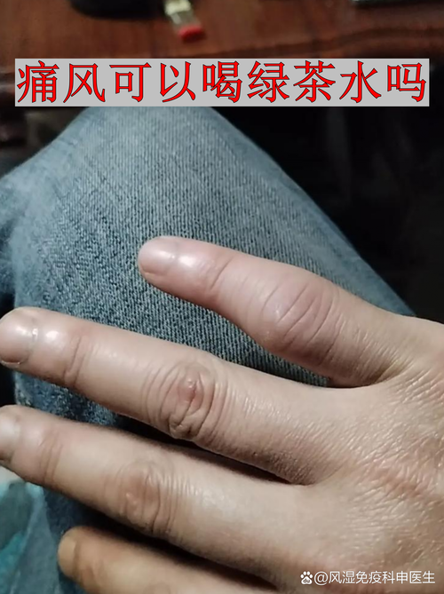 痛风喝什么茶能降尿酸