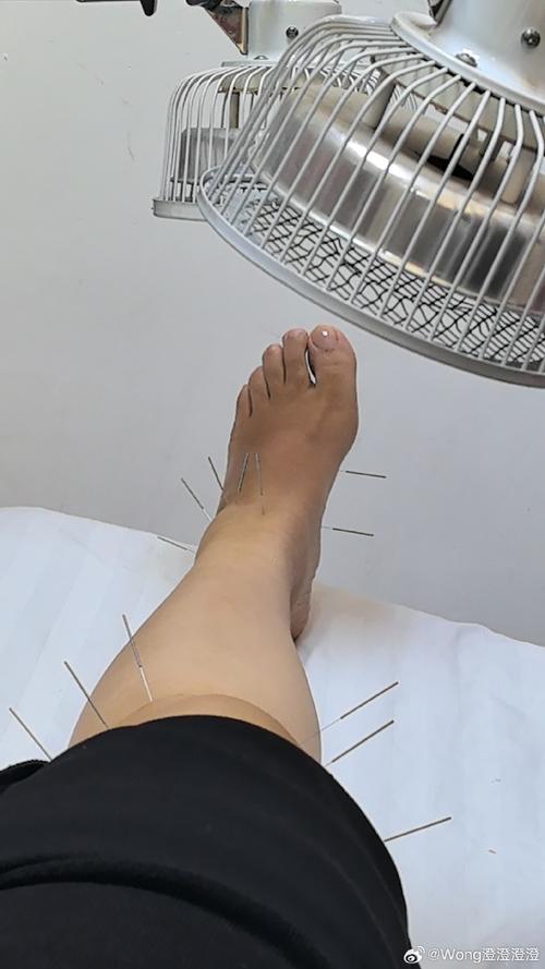 双下肢疼痛针灸治疗