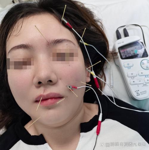 面瘫换医生针灸好吗