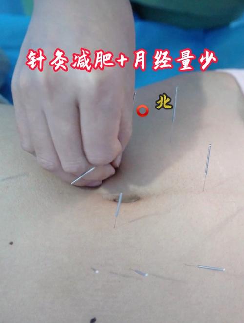 针灸以后不来例假了