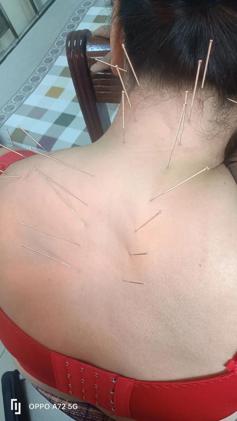 酒后多久才能做针灸