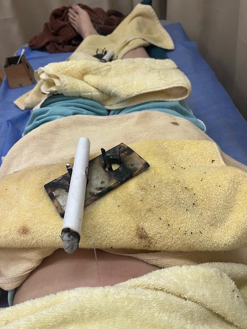 青岛哪家医院针灸好