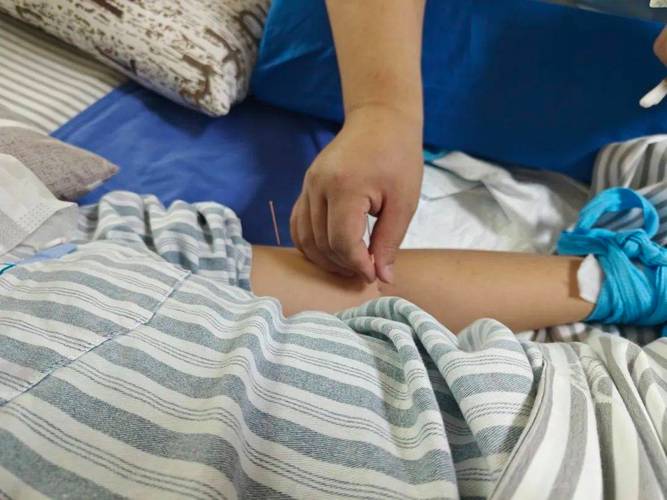 脑血栓针灸治疗好吗