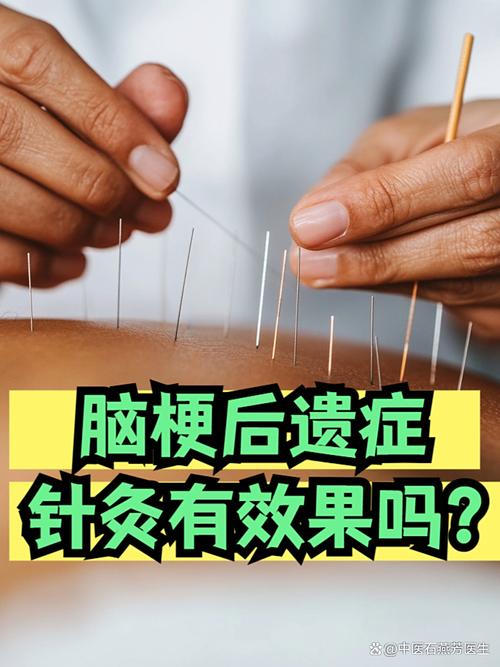 脑血栓针灸治疗好吗