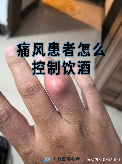 痛风喝酒抽烟有关系吗