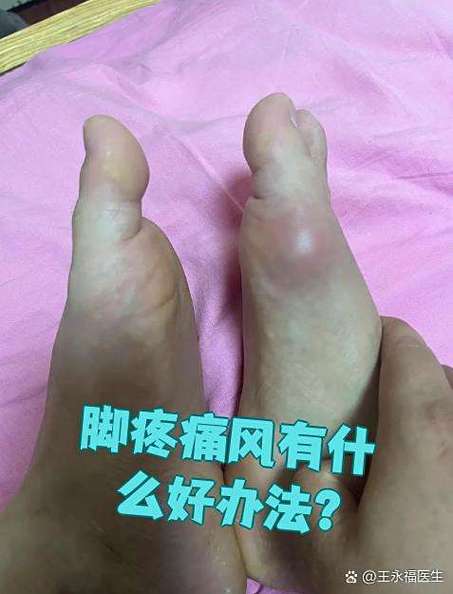 痛风在脚上的症状图片