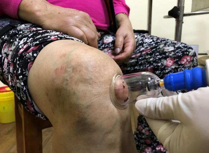 痛风刺络放血疗法视频