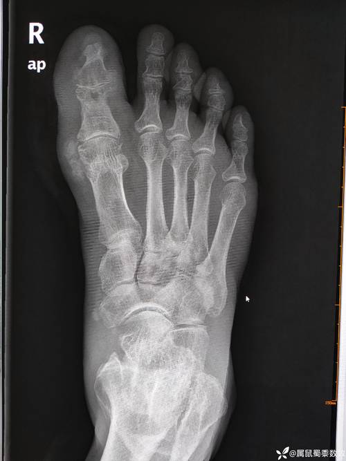 脚踝痛风石爆裂的图片