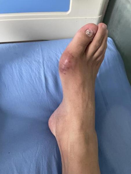 脚踝痛风石爆裂的图片
