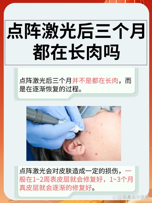 激光去除黑色素安全吗