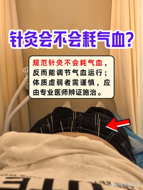 针灸会不会导致气虚