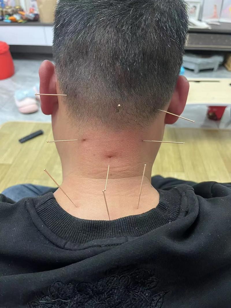 保山针灸培训哪家好