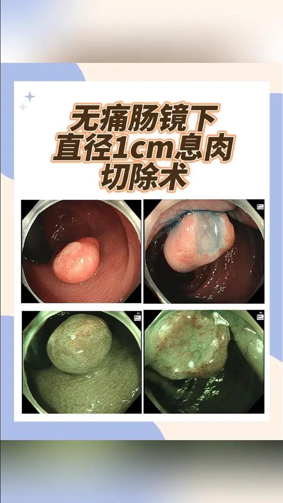 肠镜下切除息肉安全吗