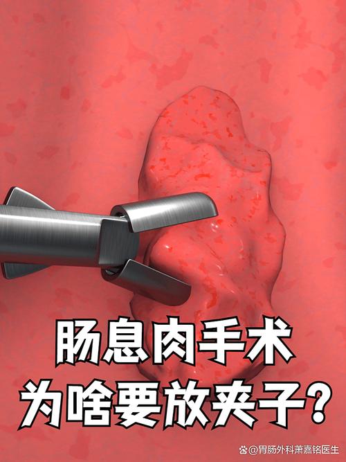 肠镜下切除息肉安全吗