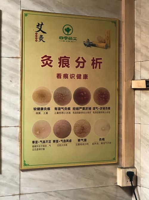 针灸过后可以艾灸吗