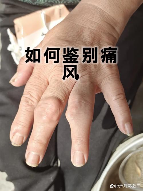 早期痛风的症状及治疗