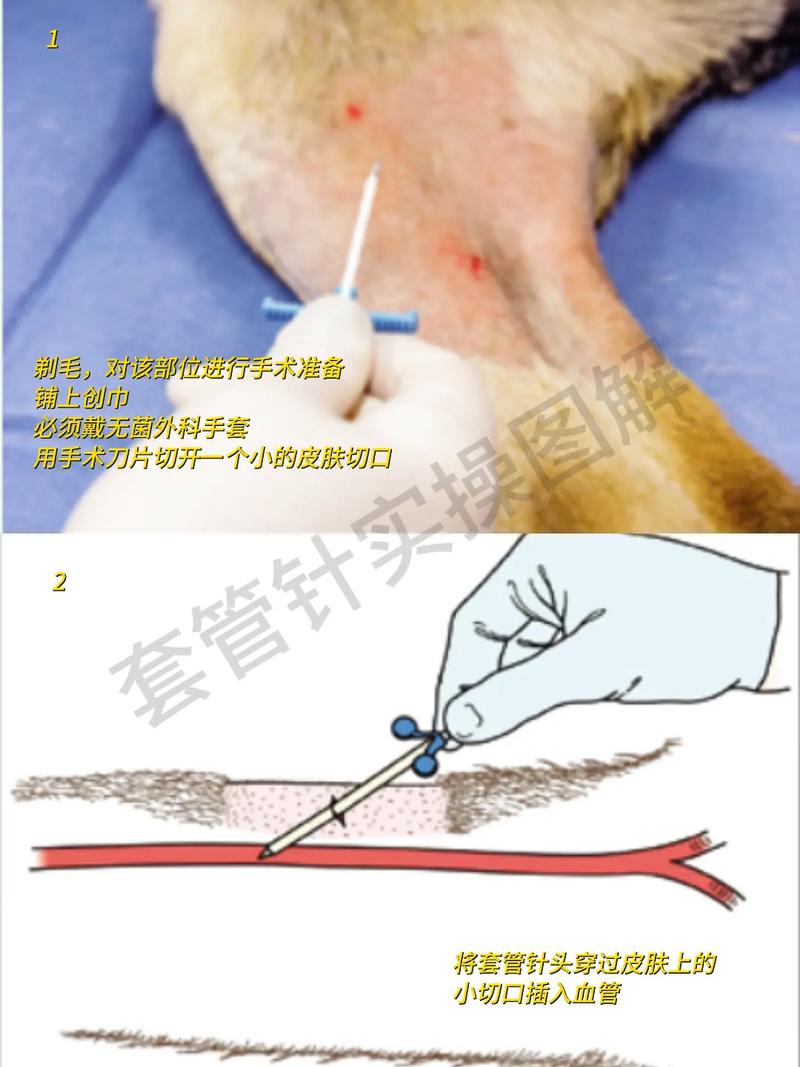 套管针灸针怎么使用
