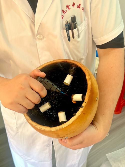 痛风可以针灸拔火罐